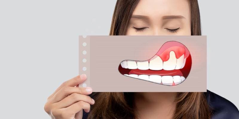 Gülüş Tasarımında Pembe Estetik: Gummy Smile (Diş Eti Görünümü) Tedavisi