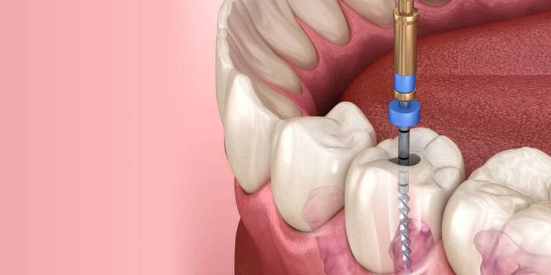 Kanal Tedavisi (Endodonti)