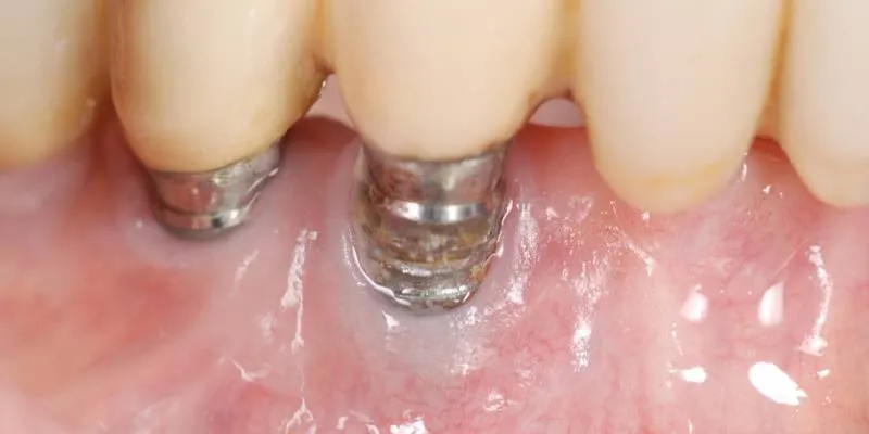 İmplant Çevresi Diş Eti Hastalıkları (Peri-implantitis)